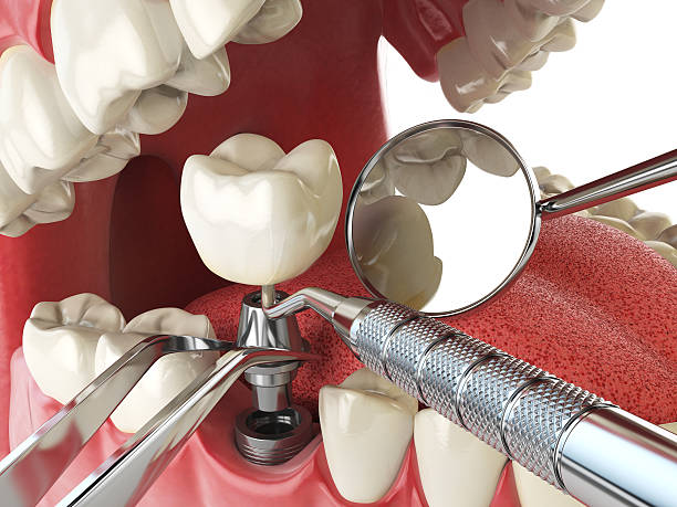 Best Emergency Root Canal Treatment in Middletown, CT